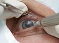 Cirurgia que altera cor do olho tem uso restrito para pessoas cegas